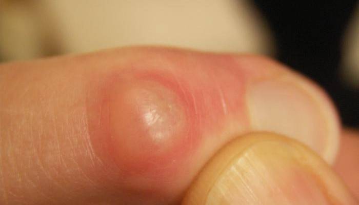 Шишки на пальцях рук лікування народними засобами Шишки на пальцях рук лікування народними засобами