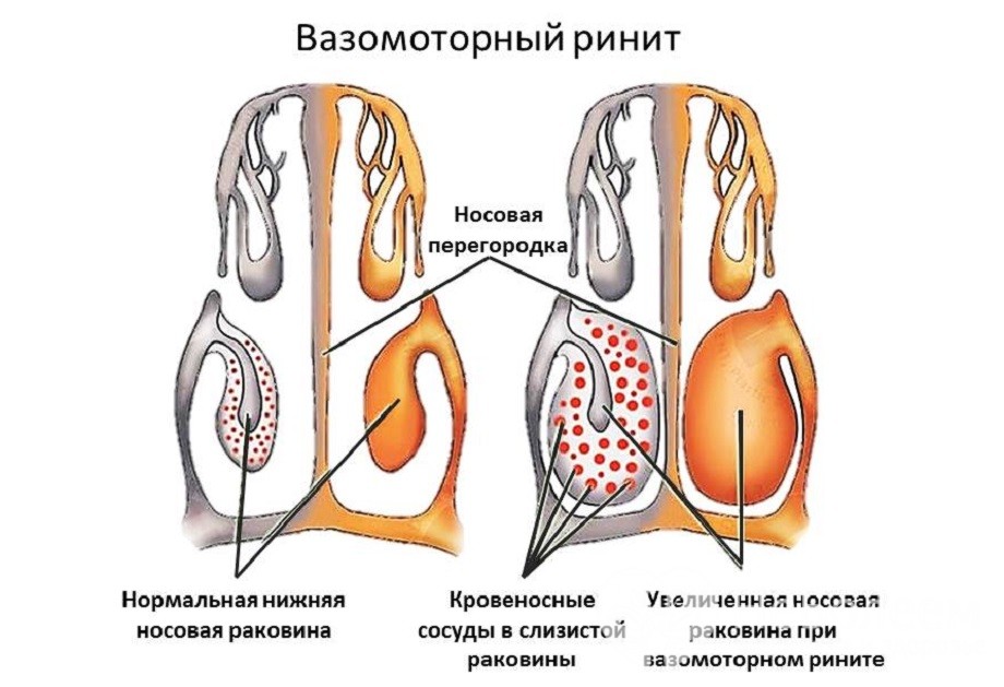 Симптоматика і правила лікування вазомоторного риніту