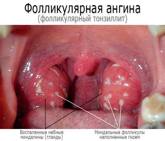 Симптоми ангіни як розпізнати і вилікувати