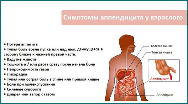 Симптоми апендициту у жінок і чоловіків: перші ознаки