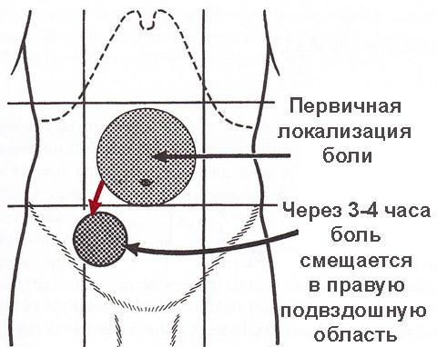 Симптоми апендициту у жінок і чоловіків: перші ознаки