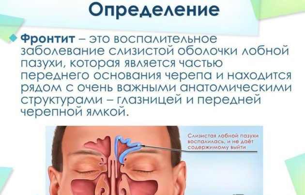 Симптоми фронтиту і його лікування в домашніх умовах