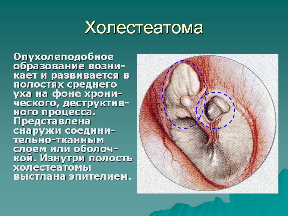 Симптоми холестеатоми та його лікування
