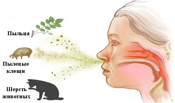 Симптоми і лікування алергічного ларинготрахеїту у дорослих і дітей