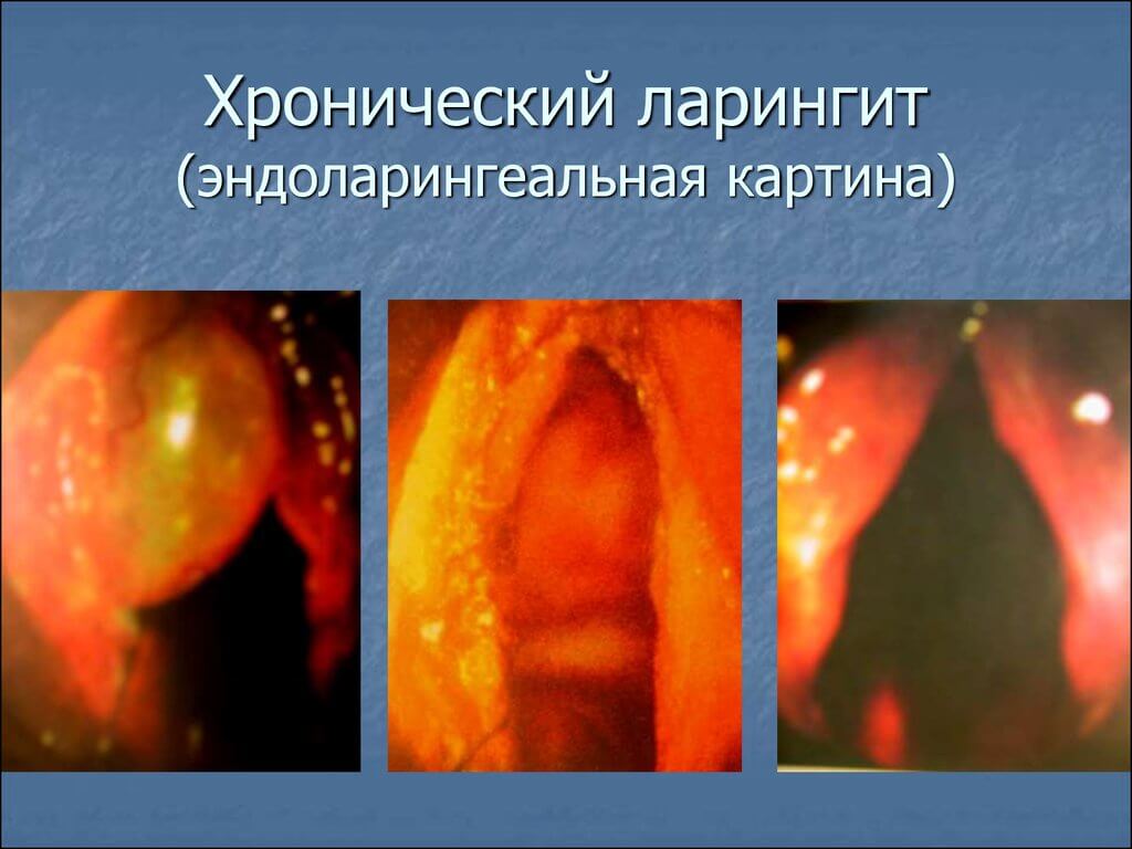 Симптоми ларингіту у дорослих і способи лікування захворювання