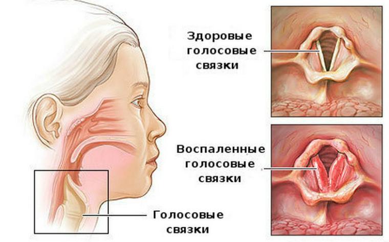Симптоми ознаки та лікування ларингіту