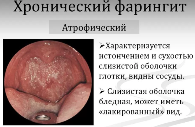 Симптоми та лікування атрофічного фарингіту