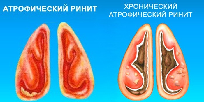 Симптоми та лікування атрофічного риніту