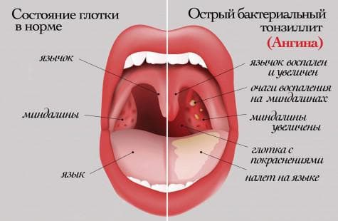 Симптоми та лікування бактеріальної ангіни