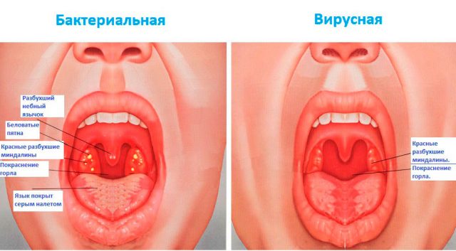Симптоми та лікування бактеріальної ангіни
