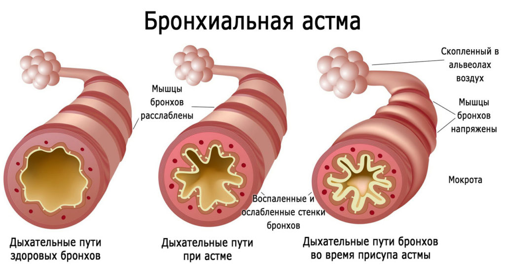 Симптоми та лікування бронхіальної астми у дорослих