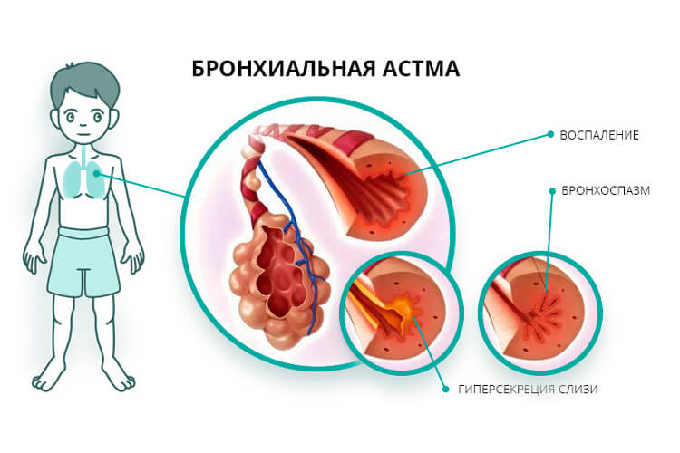 Симптоми та лікування бронхіальної астми у дорослих