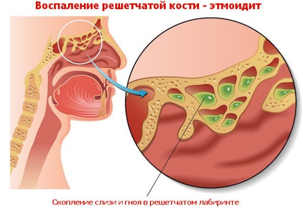 Симптоми та лікування етмоїдиту у дітей