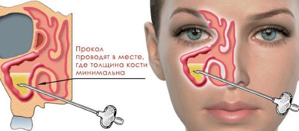 Симптоми та лікування етмоїдиту у дітей