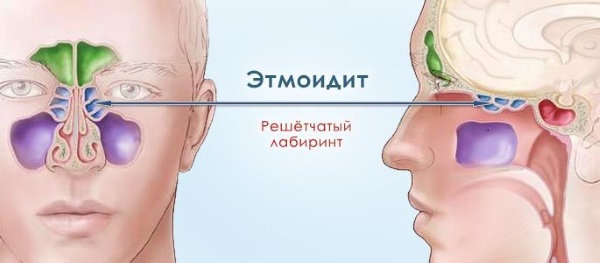 Симптоми та лікування етмоїдиту у дітей