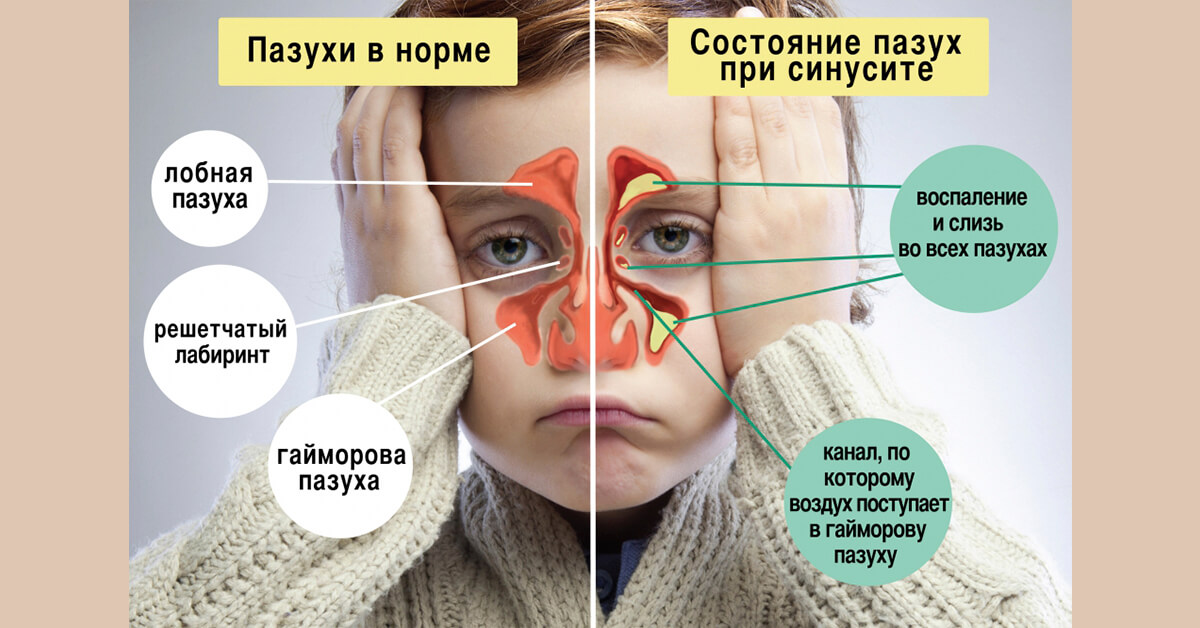 Симптоми та лікування гнійного гаймориту