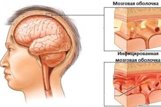 Симптоми та лікування хронічного гаймориту синуситу у дорослих назавжди