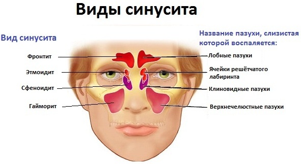 Симптоми та лікування хронічного риносинуситу