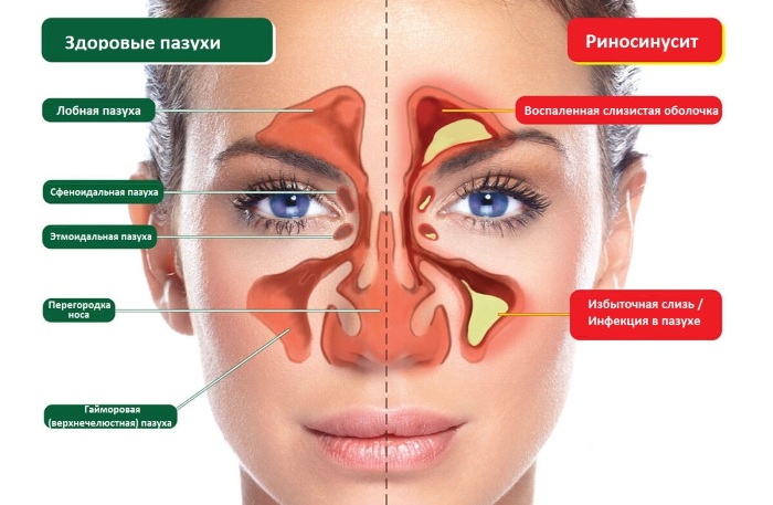 Симптоми та лікування хронічного риносинуситу
