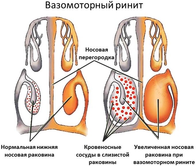 Симптоми та лікування хронічного риносинуситу