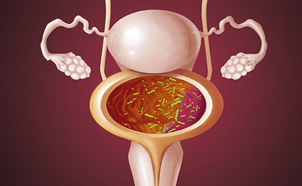 Симптоми та лікування хвороби сечового міхура у жінок