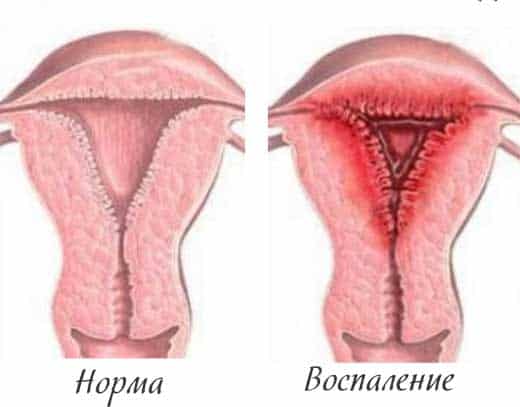 Симптоми та лікування хвороби сечового міхура у жінок