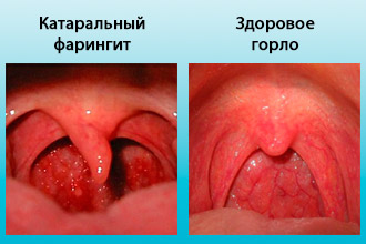 Симптоми та лікування катарального фарингіту