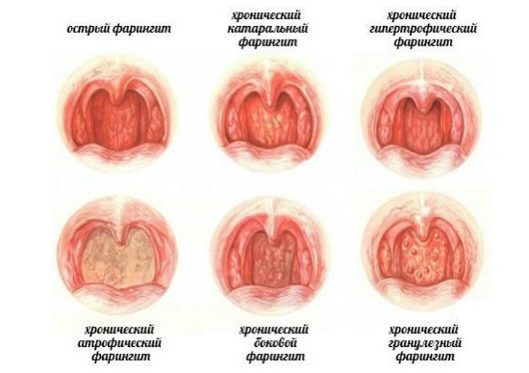 Симптоми та лікування ларингіту і фарингіту у дорослих