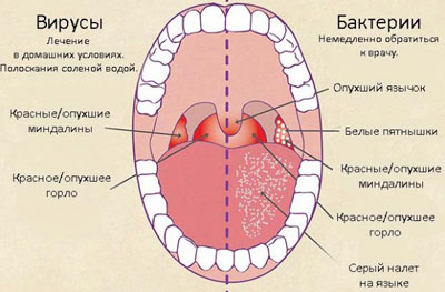 Симптоми та лікування ларингіту і фарингіту у дорослих