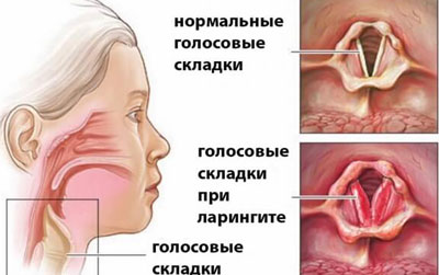 Симптоми та лікування ларингіту і фарингіту у дорослих