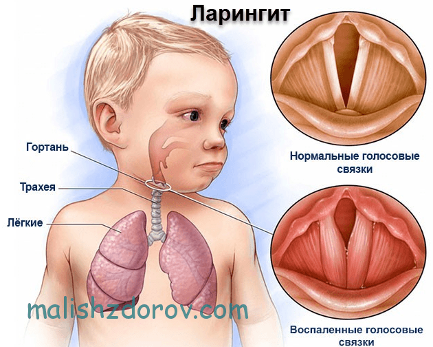 Симптоми та лікування ларингіту у дітей швидко в домашніх умовах