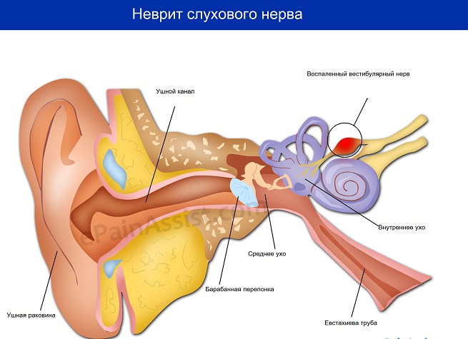 Симптоми та лікування невриту слухового нерва