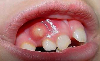 Симптоми та лікування одонтогенного гаймориту синусит з-за хворого зуба
