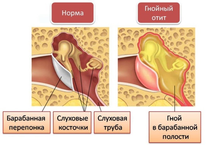 Симптоми та лікування отиту у дитини 2 років
