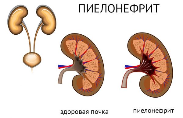 Симптоми та лікування піску в сечовому міхурі у жінок: препарати, настої трав, дієта