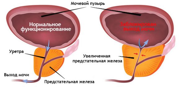 Симптоми та лікування піску в сечовому міхурі у жінок: препарати, настої трав, дієта