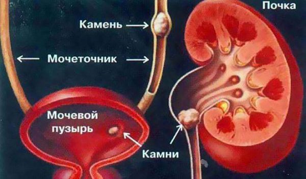 Симптоми та лікування піску в сечовому міхурі у жінок: препарати, настої трав, дієта