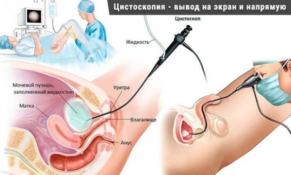 Симптоми та лікування піску в сечовому міхурі у жінок: препарати, настої трав, дієта