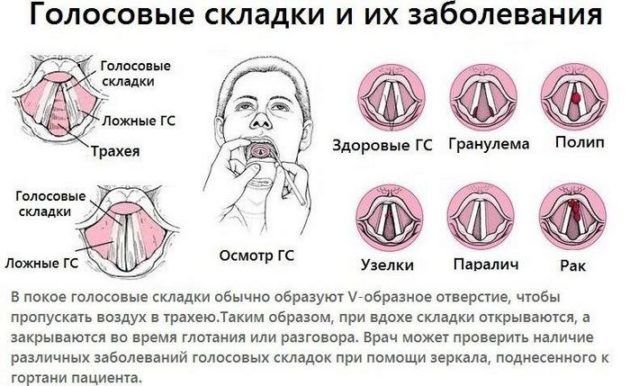 Симптоми та лікування парезу гортані