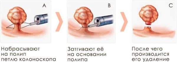 Симптоми та лікування поліпів у носі у дитини відео