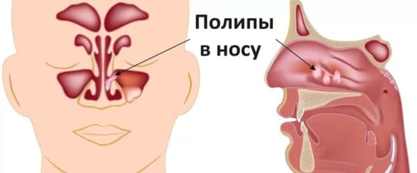 Симптоми та лікування поліпів у носі у дитини відео