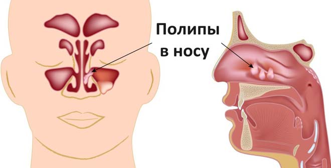 Симптоми та лікування поліпів у носі у дорослих