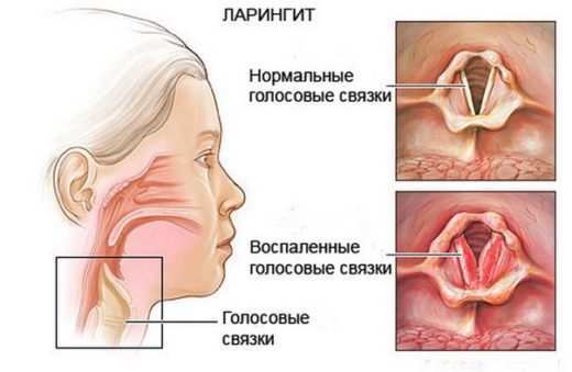 Симптоми та лікування стенозуючого ларингіту у дорослих і дітей