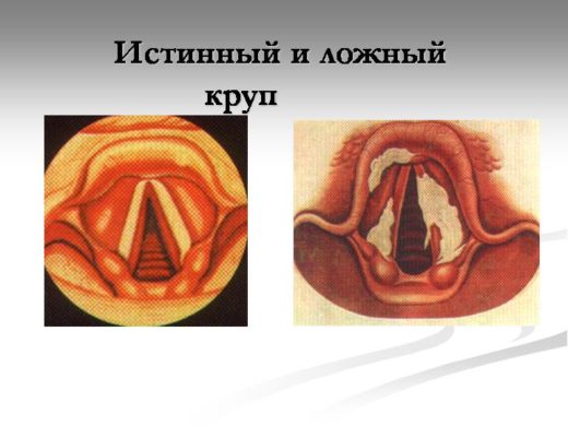 Симптоми та лікування стенозуючого ларингіту у дорослих і дітей