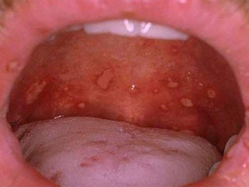 Симптоми та лікування стоматиту у горлі