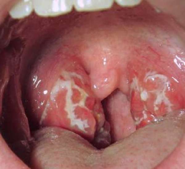 Симптоми та лікування стрептококової інфекції горла