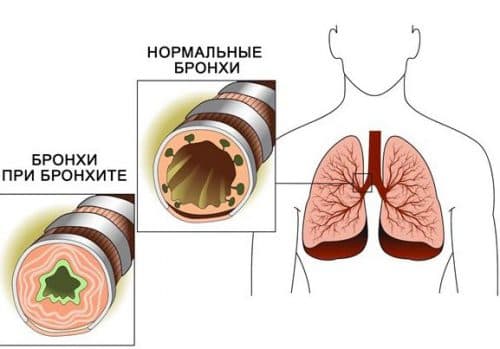Симптоми та лікування трахеїту у дітей в домашніх умовах