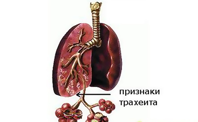 Симптоми та лікування трахеїту у дітей в домашніх умовах