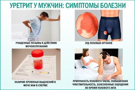 Симптоми та лікування уретриту у чоловіків