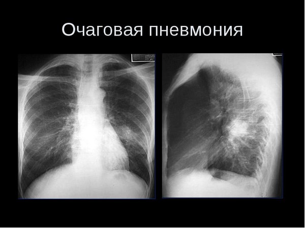 Симптоми та лікування запалення легенів